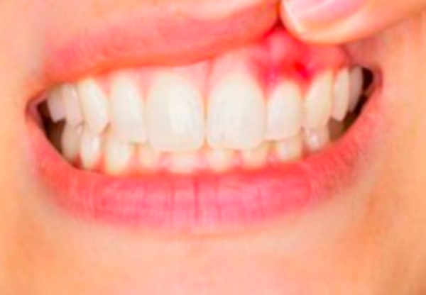 How to Treat Gum Disease?