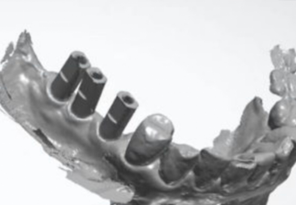 Best solutions for digital dental implant cases!