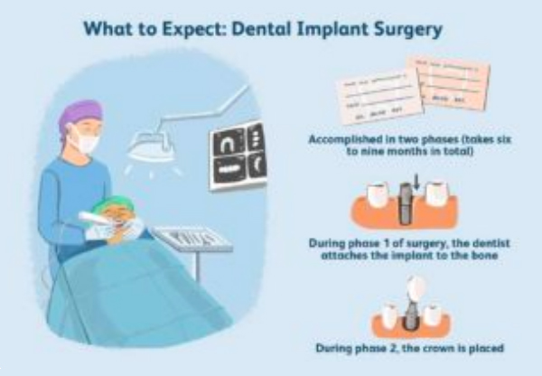 How to Prepare for a Dental Implant Procedure?