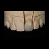 Zirconia Crowns Manufacturer