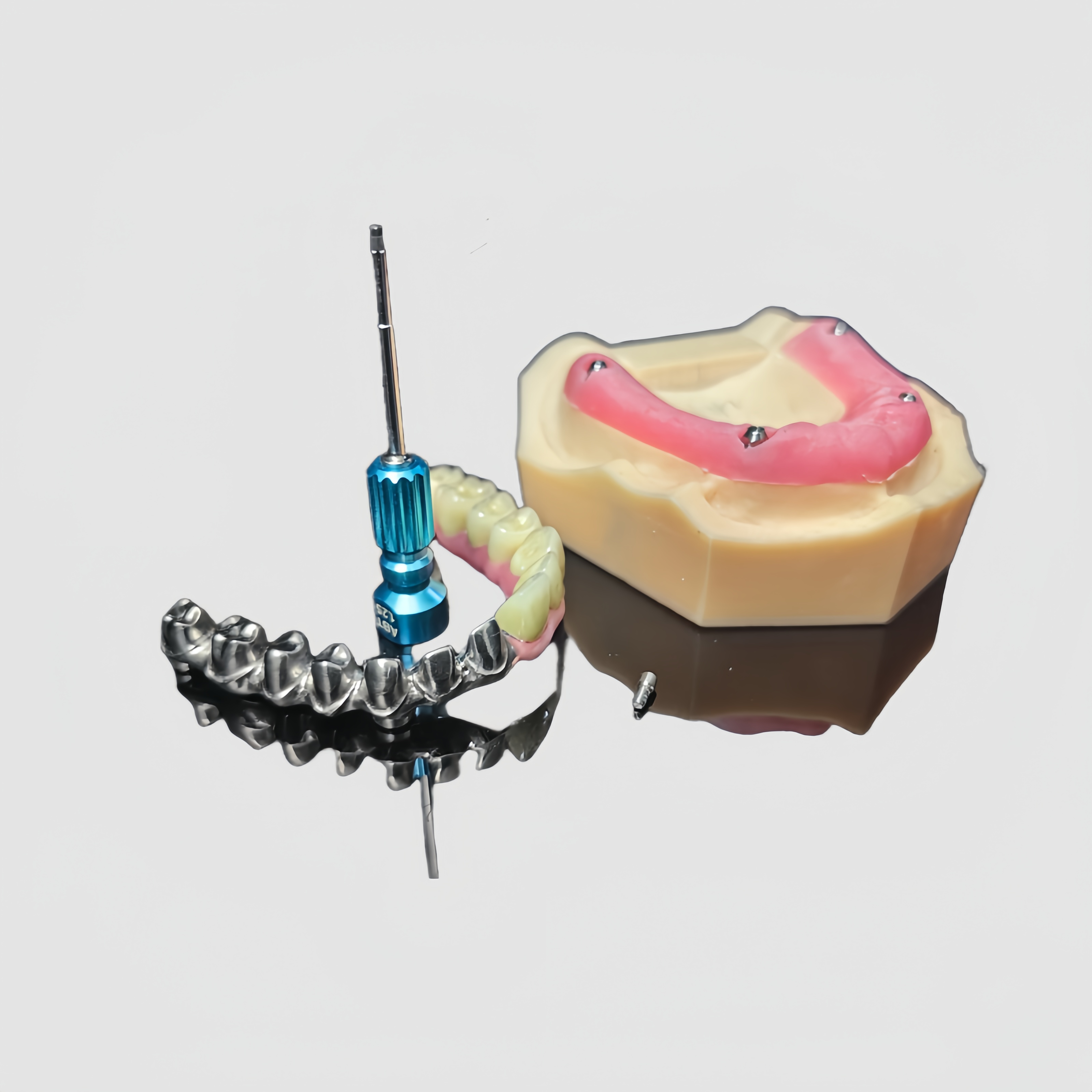 Malo Implant Bridge