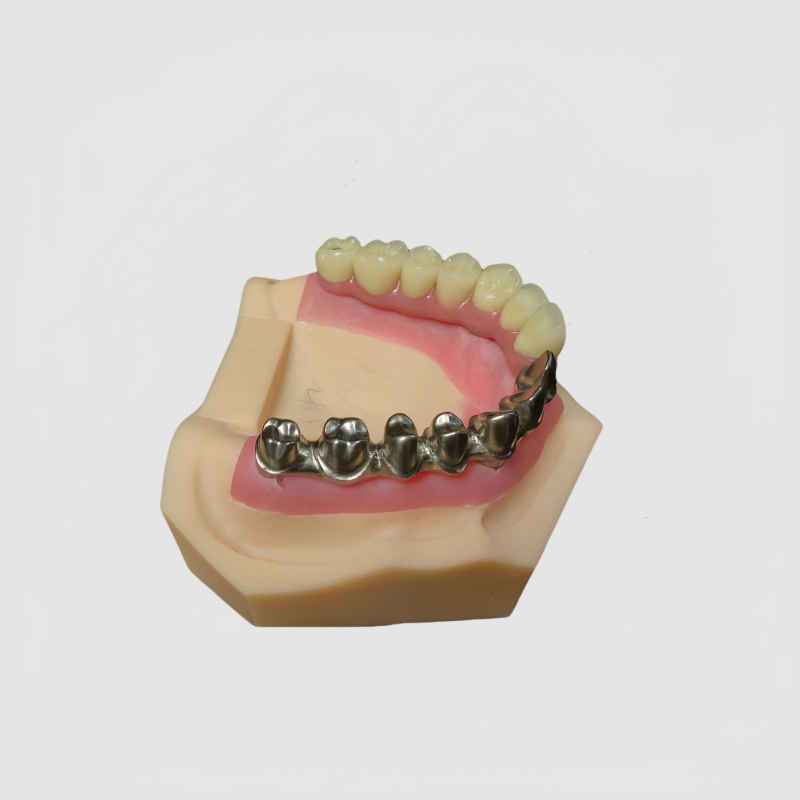Malo Implant Bridge