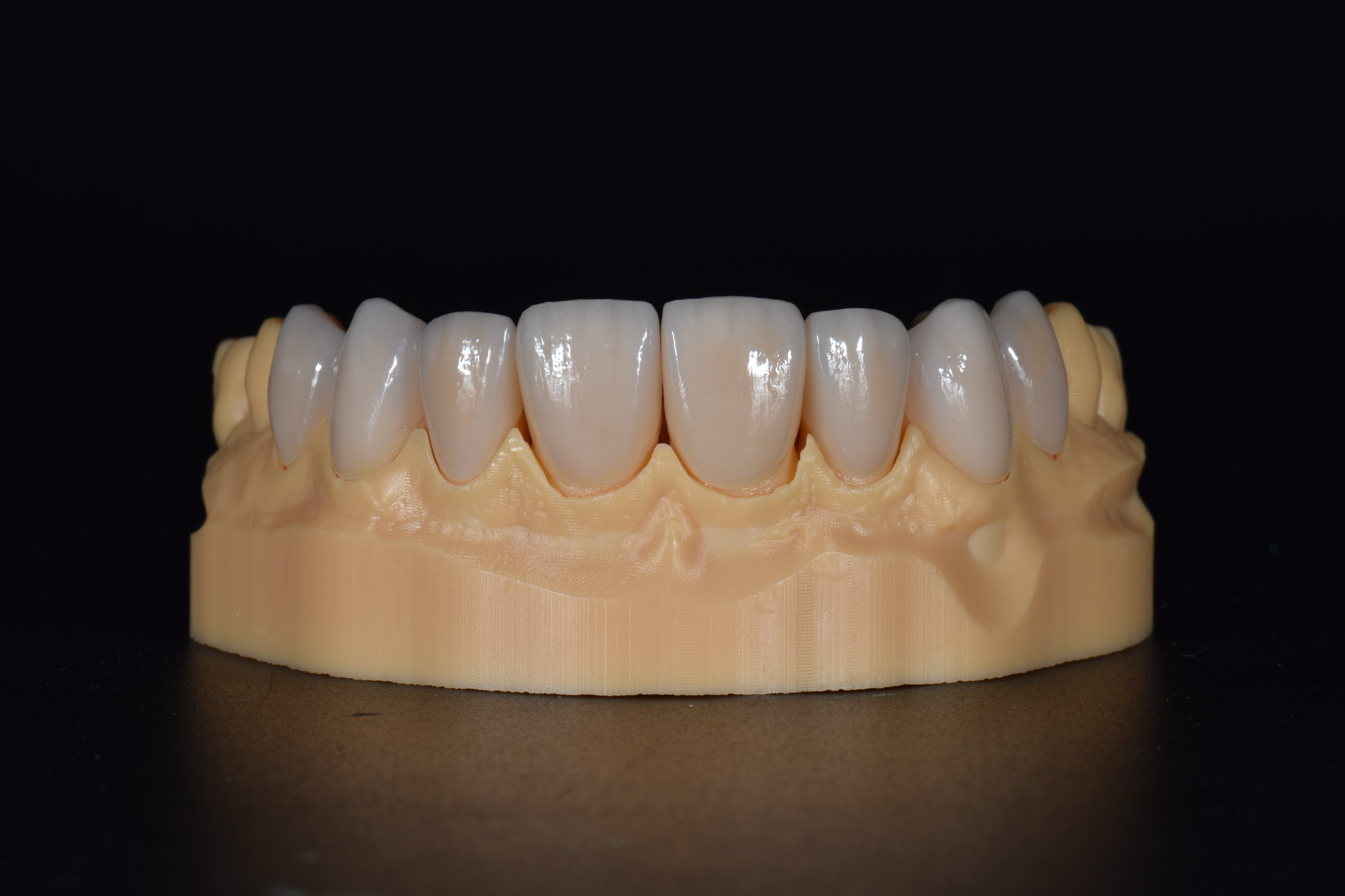 China Emax Crowns Manufacturing Service