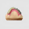 Malo Implant Bridge