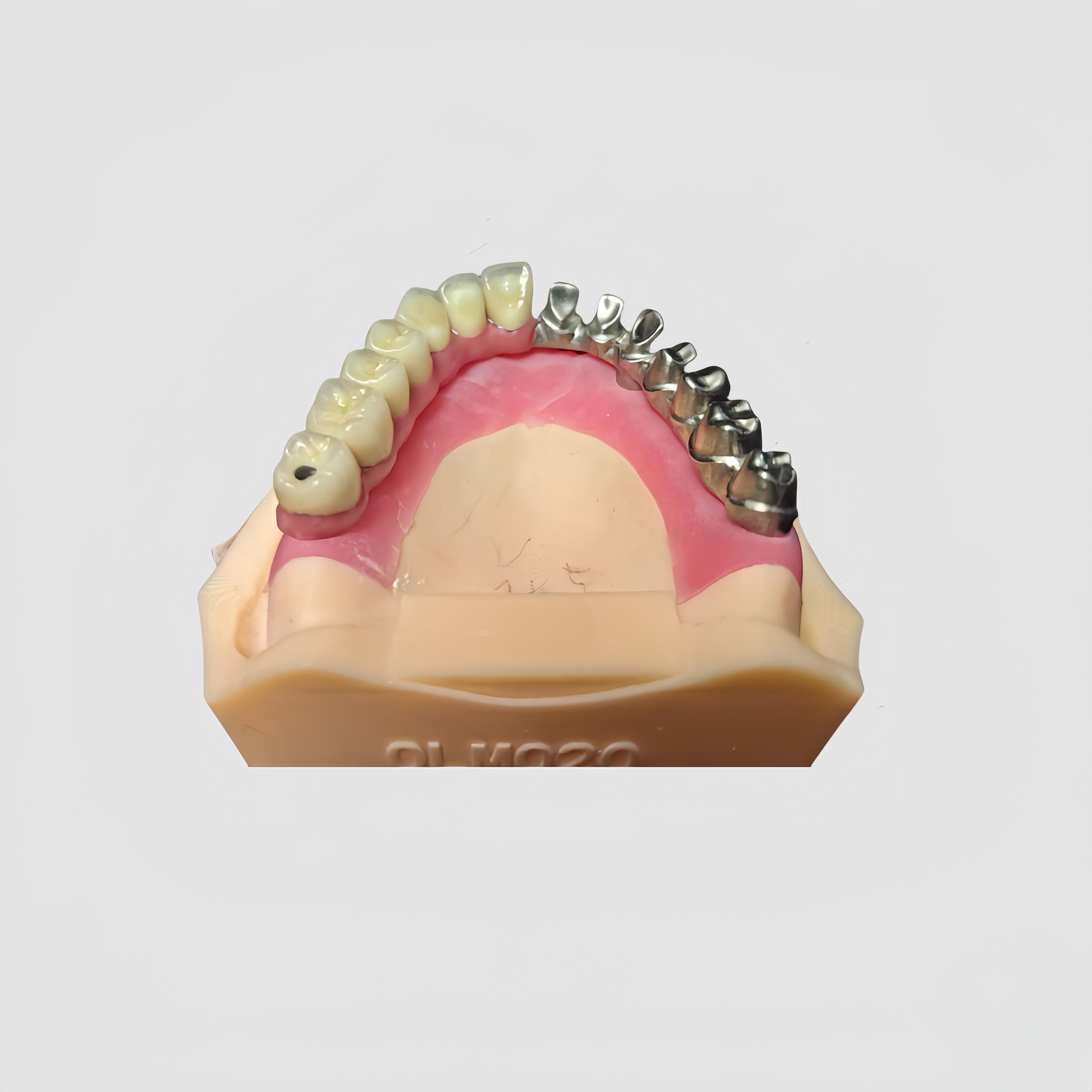 Malo Implant Bridge